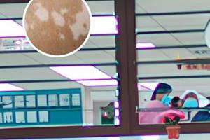 308準分子激光治療一次要多久